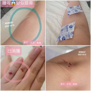 摔跤跌傷又瘀又腫的時候....*